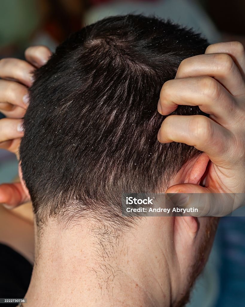 Dandruff and Scalp Infections: Causes, Symptoms, and Effective Treatment